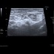Reactive lymph nodes in interferon treatment: US - Ultrasound